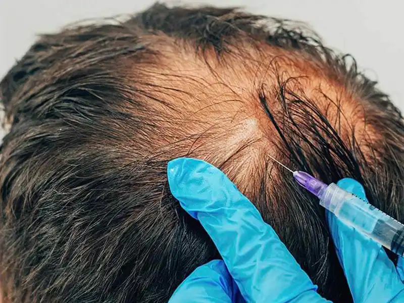 Plasma-Rico-en-Plaquetas-2