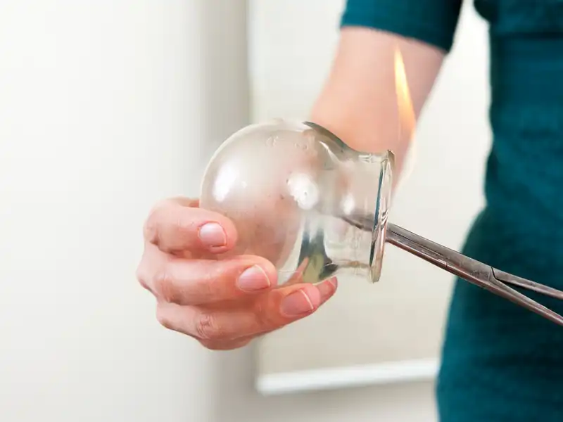 Terapia con Ventosas